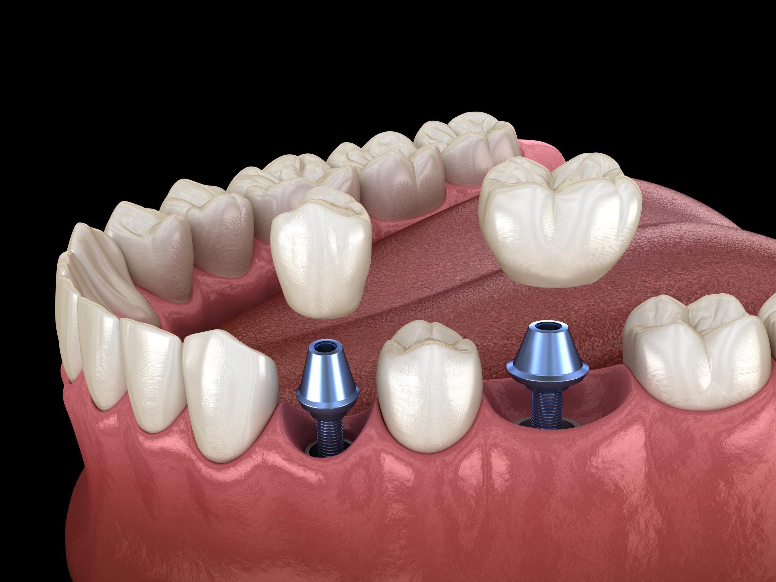 The Hidden Benefits of Dental Implants Beyond Aesthetics